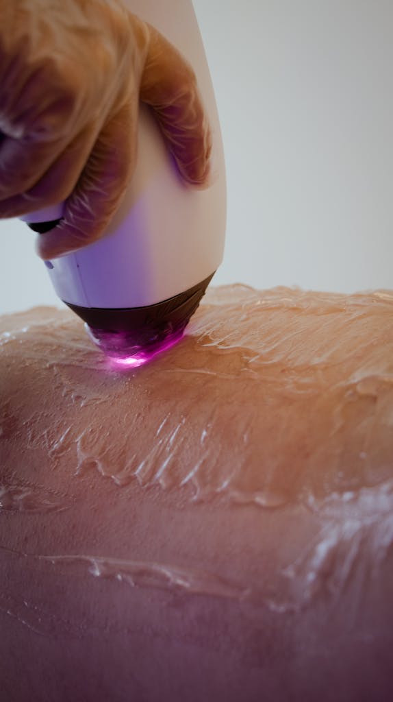 Close-up of laser skincare treatment on skin with visible hand holding device.